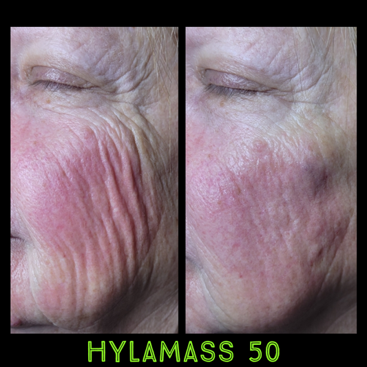 Hyalmass 50 High Concentrated HA Skin Booster: Your Ultimate Guide to Firmer, Youthful Skin